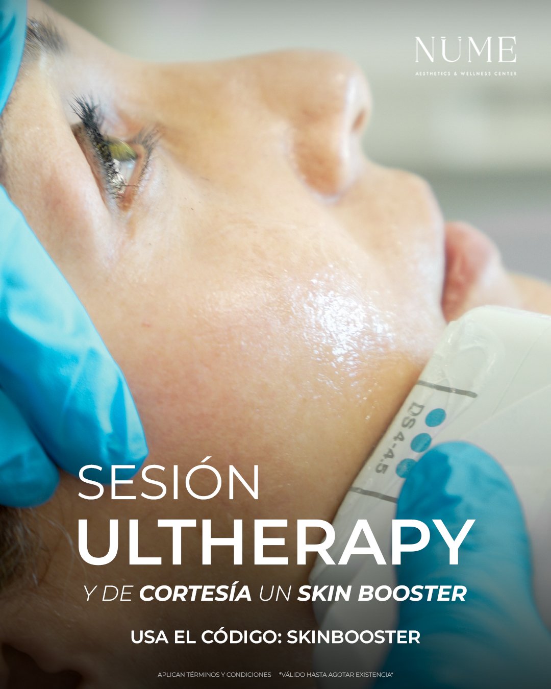 Promocion Ultherapy Prime lifting sin cirugia en NuMe Cancun